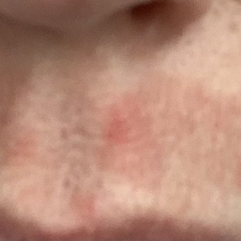 Essence Nails & Spa - Burn from lip wax - Nail Salons Near Me - Portland, Oregon Essence Nails & Spa - Burn from lip wax - Nail Salons Near Me - Portland, Oregon