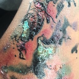 Infected 2 days into it, looks like shit. Infected 2 days into it, looks like shit.