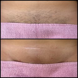 Brazilian wax