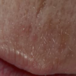 La Belle - After derma plane