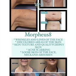 Viogene Chalcedony Aesthetics - Morpheus8 RF           face & neck and body Treatment