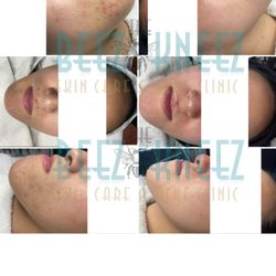The Beez Kneez Skin Care and Acne Clinic - Before & after