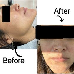 Daisy MD Care - Before and after multiple treatments