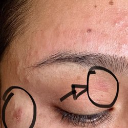 Vera Nail Spa - Wax burn