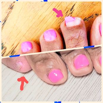 Luminous Nails & Spa - Gel polish peeling on the pinky toe with 24 hrs (bottom photo) Gel polish peeling with 4 days on a middle toe (top photo) - Nail Salons Near Me - Port St. Lucie, Florida Luminous Nails & Spa - Gel polish peeling on the pinky toe with 24 hrs (bottom photo) Gel polish peeling with 4 days on a middle toe (top photo) - Nail Salons Near Me - Port St. Lucie, Florida