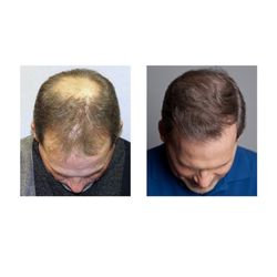 Bosley Hair Transplant & Restoration - Permanent hair restoration (hair transplantation) by Bosley