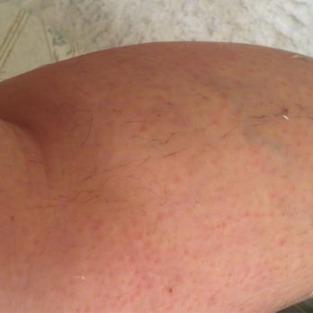 Cute Tips Nail Salon - My terrible leg wax (please excuse the red, that's me not them, but the residual hair and wax is their fault) - Nail Salons Near Me - Gaithersburg, Maryland Cute Tips Nail Salon - My terrible leg wax (please excuse the red, that's me not them, but the residual hair and wax is their fault) - Nail Salons Near Me - Gaithersburg, Maryland