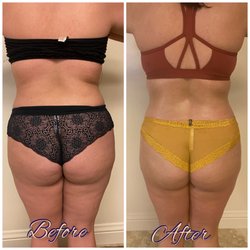 Before and after (cavitation + wood therapy)