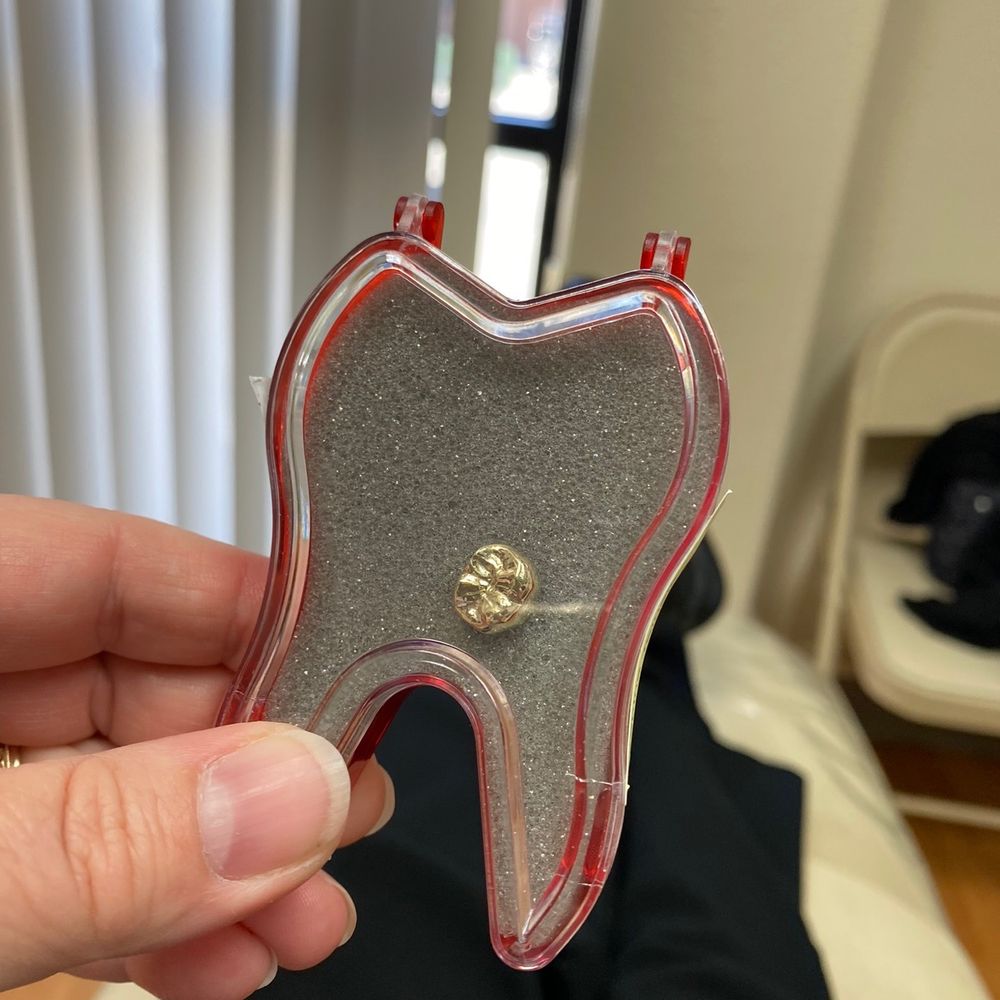 Crown Dentistry - New gold crown! - General Dentistry Near Me - Sacramento, California Crown Dentistry - New gold crown! - General Dentistry Near Me - Sacramento, California