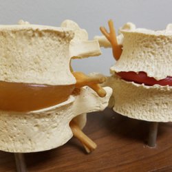 California Chiropractic - Healthy vertebrae and disc vs. unhealthy, arthritic and degenerative disc.