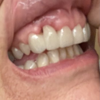Smiles By Hanna - REAL AFTER PHOTO - Cosmetic Dentists Near Me - Gilbert, Arizona Smiles By Hanna - REAL AFTER PHOTO - Cosmetic Dentists Near Me - Gilbert, Arizona