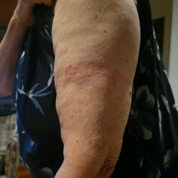 Lincoln Medical Supplies - This Is the mark the sleeve leaves.  It also leaves marks on the bottom.