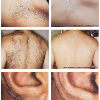Monroe Electrology - untitled - Hair Removal Near Me - Puyallup, Washington Monroe Electrology - untitled - Hair Removal Near Me - Puyallup, Washington