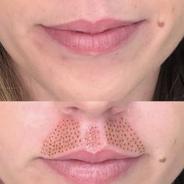 Lip flip Lip flip