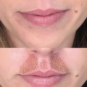 Heavenly Aesthetics - Lip flip - Aestheticians Near Me - San Diego, California Heavenly Aesthetics - Lip flip - Aestheticians Near Me - San Diego, California