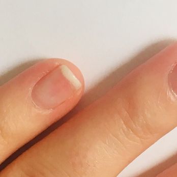 Fantasy Nail & Beauty Spa - 3 weeks post gel manicure - from the center of my nail it's pink because the salon over filed the nail overlying this region - Nail Salons Near Me - Dobbs Ferry, New York Fantasy Nail & Beauty Spa - 3 weeks post gel manicure - from the center of my nail it's pink because the salon over filed the nail overlying this region - Nail Salons Near Me - Dobbs Ferry, New York