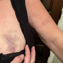 Perfect Union - Shasta Lake - Bruises from the security guy