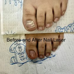 Michael Cook, DPM - Before and after nail laser treatments
