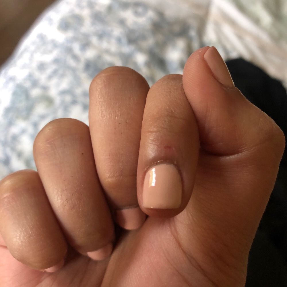 Peeled hangnail.