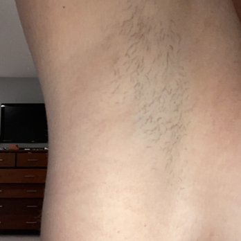 LaserAway - Tattoo Removal Near Me - Los Gatos, California
