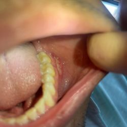 North Tarrant Dental Care - Etch burn caused by dentist office.