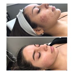 Acne Advisors - Visit 5/9 keep up the good work!!