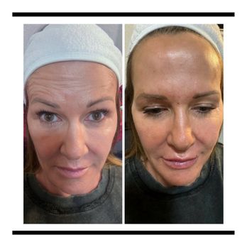 Everyday Bombshell Aesthetics - Full Face Botox : Forehead,Glabella, Crow's Feet and a Lip Flip - Medical Spas Near Me - Longview, Texas