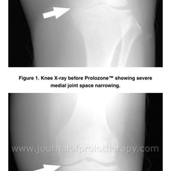 Rejuvenate Wellness Center - Prolozone Therapy for Knee