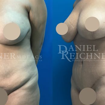 Daniel Reichner, MD, FACS - Before & After Mommy Makeover - Plastic Surgeons Near Me - Orange, California