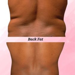 Rema's Secrets Luxury Day Spa & Body Sculpting Massage - Bra fat melting back fat melting