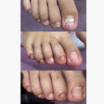 Toe BBL Vixen - Book your Reset Pedicure for better looking healthy feet. A Toe BBL will change the way you see your feet; after years not showing your feet - Nail Technicians Near Me Toe BBL Vixen - Book your Reset Pedicure for better looking healthy feet. A Toe BBL will change the way you see your feet; after years not showing your feet - Nail Technicians Near Me