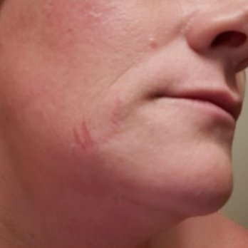 Facial Town Beauty Salon - Exposed skin - Layers of skin removed - picture taken 20 minutes after wax. - Skin Care Near Me - Mountain View, California Facial Town Beauty Salon - Exposed skin - Layers of skin removed - picture taken 20 minutes after wax. - Skin Care Near Me - Mountain View, California