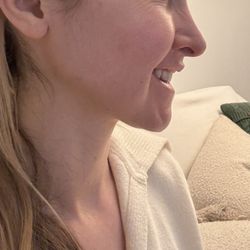 Los Angeles Center for Oral And Maxillofacial Surgery - 6 weeks post op revision double jaw surgery
