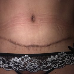 Aqua Plastic Surgery - Dr. Dev did the surgery. Stomach is still numb 1.5 years later.