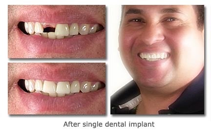 Before & After Dental Work - Here is some before and after photos of what I was able to do with some patients.  Helping them improve their smile daily.  Come into the office for a Free Consultation