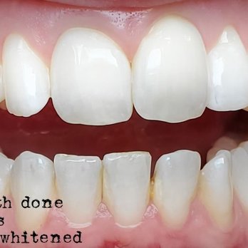 Whitening at Tiffany's - This really highlights the results you can achieve in minutes! - Teeth Whitening Near Me