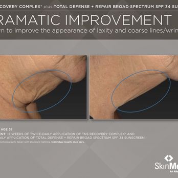 LooksRx - 12 weeks after using TNS Recovery Complex by Skin Medica. - Medical Spas Near Me - Garland, Texas LooksRx - 12 weeks after using TNS Recovery Complex by Skin Medica. - Medical Spas Near Me - Garland, Texas