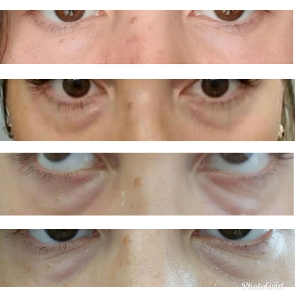 WrinkleFree MD - Tear Trough gone way wrong. - Medical Spas Near Me - Leander, Texas