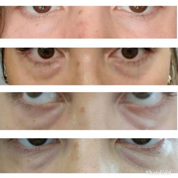 WrinkleFree MD - Tear Trough gone way wrong. - Medical Spas Near Me - Leander, Texas