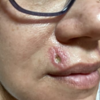 Regency Dermatology - The pa took out my stitches and it came open again . I have an open scar now - Medical Spas Near Me - Phoenix, Arizona