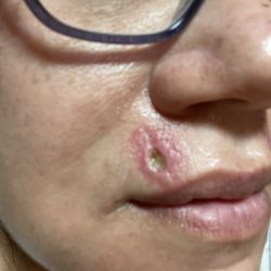 Regency Dermatology - The pa took out my stitches and it came open again . I have an open scar now