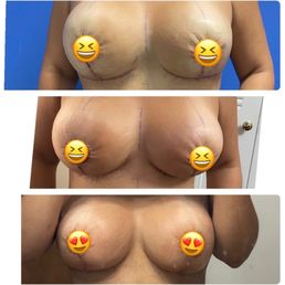 1 day po, 7 days po, and 14 days post op. Look how much of a difference two weeks have made. Can't wait until I'm fully healed! 1 day po, 7 days po, and 14 days post op. Look how much of a difference two weeks have made. Can't wait until I'm fully healed!