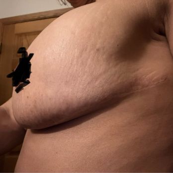 Shah Rajendra MD - Picture of my left breast shows how high and bulging out the implants are/under nipple is the horrific separation of the real fat tissue - Doctors Near Me - Oak Lawn, Illinois Shah Rajendra MD - Picture of my left breast shows how high and bulging out the implants are/under nipple is the horrific separation of the real fat tissue - Doctors Near Me - Oak Lawn, Illinois