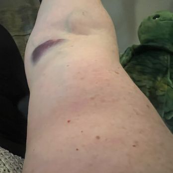 Labcorp - I now have two bruises and I look like a heroine user and have a professional event on Friday. I'm livid. - Laboratory Testing Near Me - Jacksonville, Florida Labcorp - I now have two bruises and I look like a heroine user and have a professional event on Friday. I'm livid. - Laboratory Testing Near Me - Jacksonville, Florida