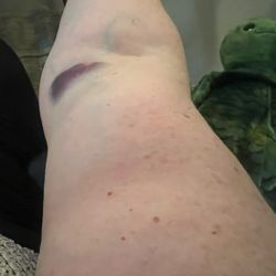 Labcorp - I now have two bruises and I look like a heroine user and have a professional event on Friday. I'm livid.