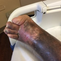 Blessing Hospital Wound Healing & Hyperbaric Center - The untreated bone infection left my husband in severe pain, his skin was damaged up to just below the knee.
