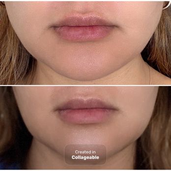 SkinSpirit - Plano - Top photo: 04/11/2025   Bottom: 6/1/2025 - Skin Care Near Me - Plano, Texas