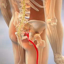 Horine Chiropractic - Sciatica