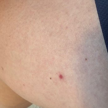 Clackamas Inn - 1/5 bedbug bites - Hotels Near Me - Clackamas, Oregon