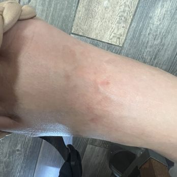Dali Nails & Lashes - Scratch marks from the callus remover! - Nail Salons Near Me - Yucaipa, California
